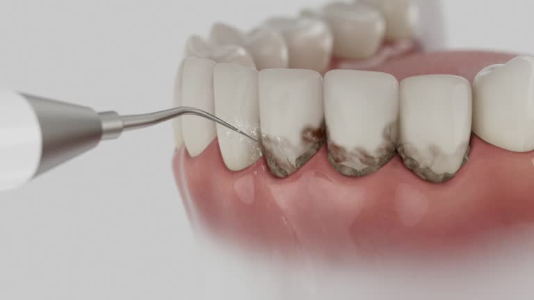 Trusted Wisdom Tooth Removal service in Draper, UT - Dentist Open Now